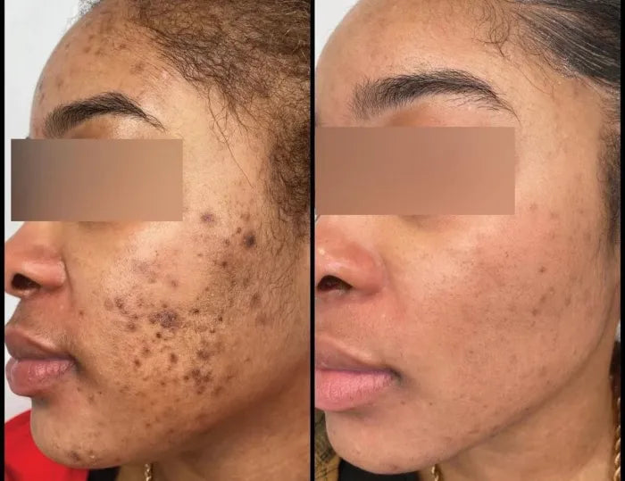 Turmibar - Turmeric Anti-Spots & Hyperpigmentation Soap Bar